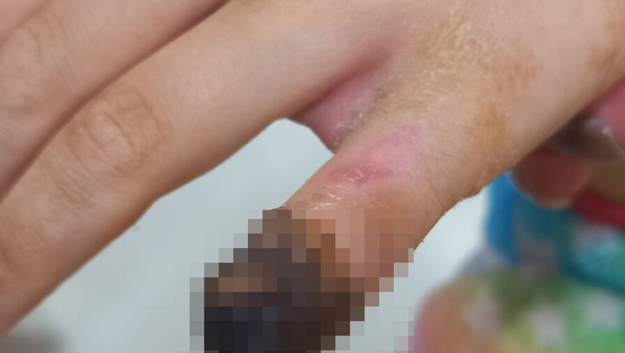 Девочке оторвало палец на площадке в Воронеже, семья третий год добивается справедливости