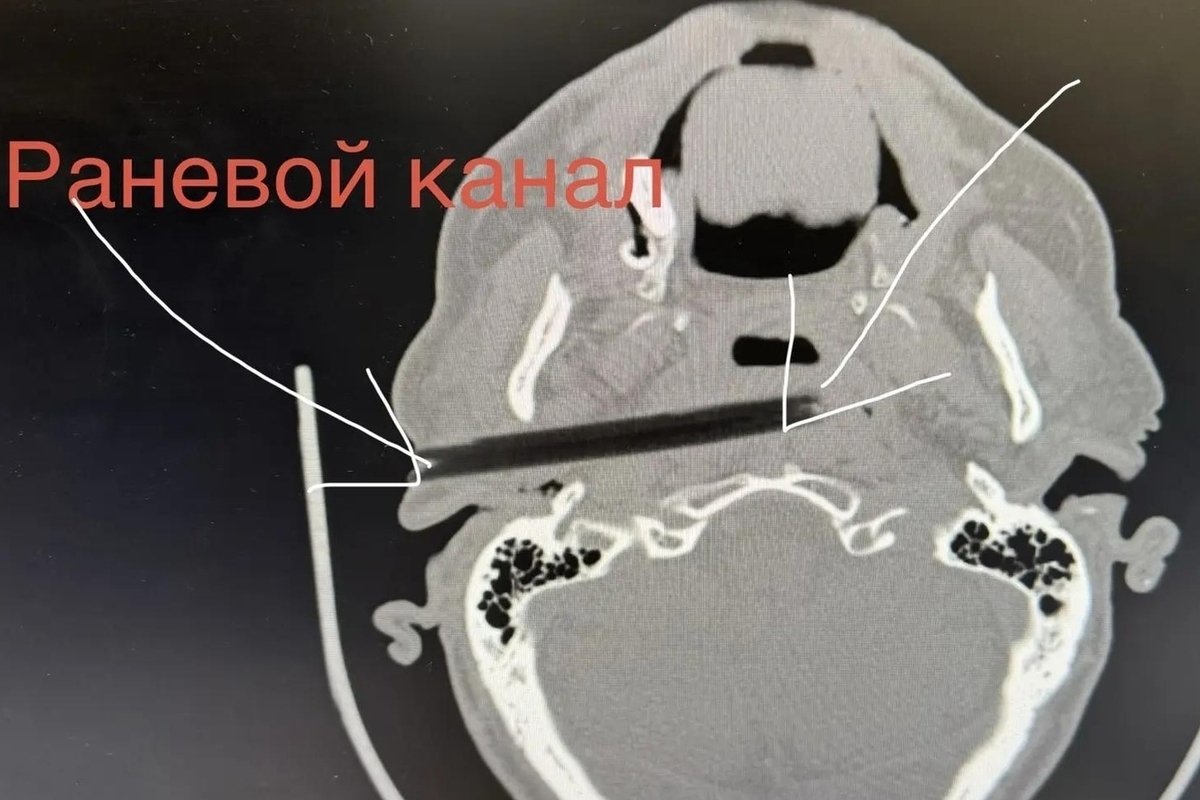 Врачи достали из головы ивановца ветку длиной 10 см