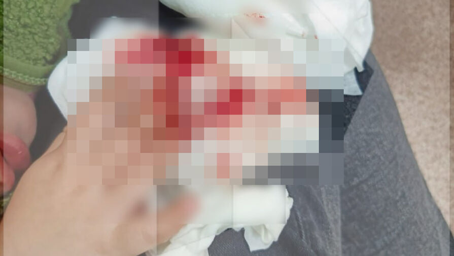 Двухлетней девочке сломали два пальца в тюменском детсаду