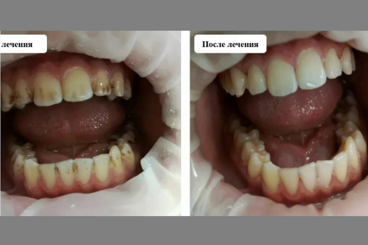 У 12-летнего воронежца появился темный налет на зубах от чая и кока-колы