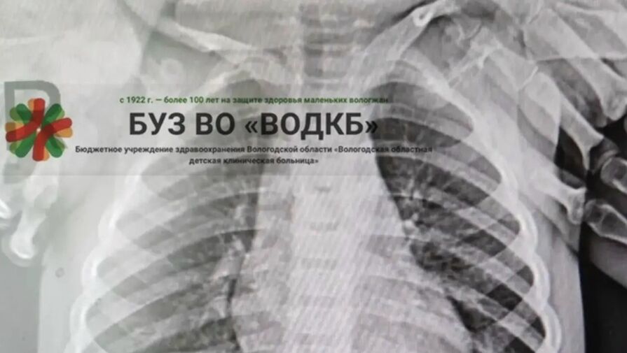 Вологодские врачи спасли двухлетнюю девочку, проглотившую 18 магнитных шариков