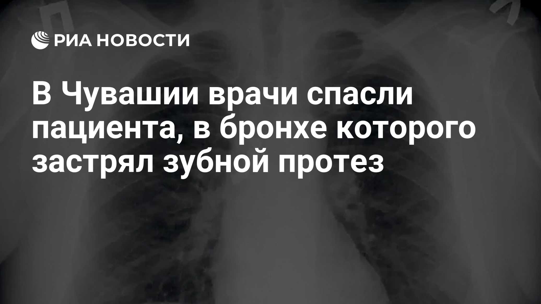 В Чувашии врачи спасли пациента, в бронхе которого застрял зубной протез