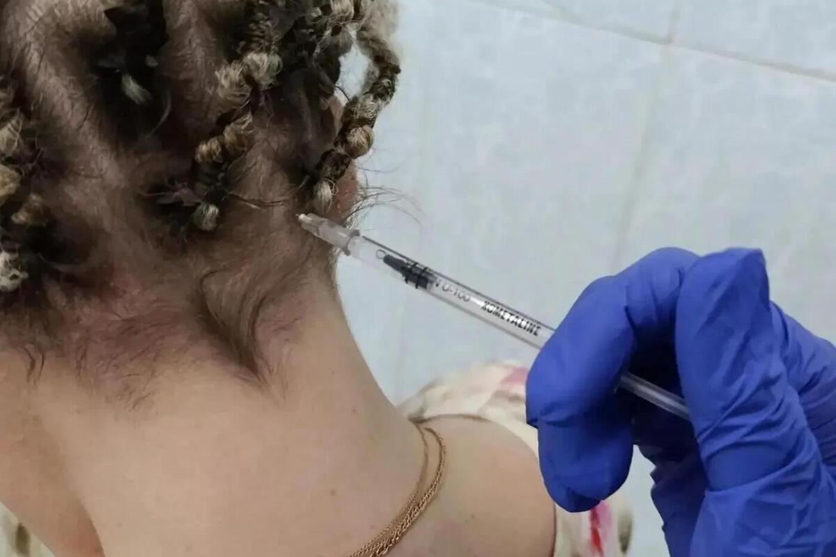 В Челябинске пациентам с хронической мигренью проводят ботулинотерапию по ОМС